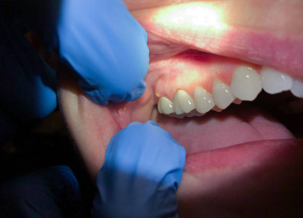 Best Emergency Treatment for Dental Infections or Abscesses in Waterville, OH