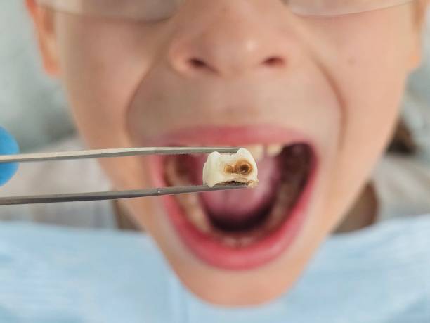 Best Emergency Dental Care for Broken or Chipped Teeth in Waterville, OH